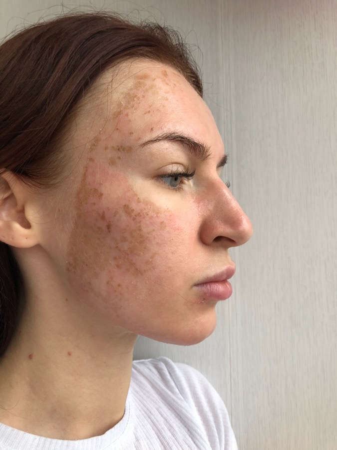 Лазерная шлифовка ожога 3 степени