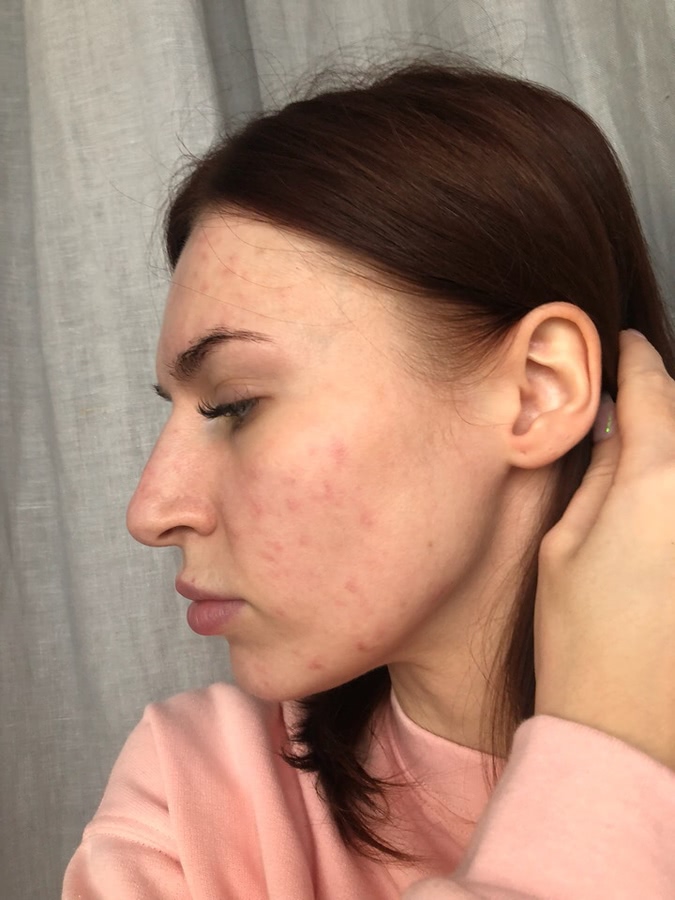 Лазерная шлифовка лица. Как это было: дневник реабилитации+ фото