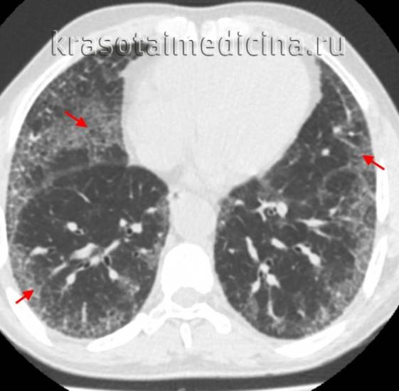 КТ ОГК. Интерстициальная пневмония, участки «матового стекла» (красная стрелка) и ретикулярные изменения. КТ ОГК. Интерстициальная пневмония, участки «матового стекла» (красная стрелка) и ретикулярные изменения.