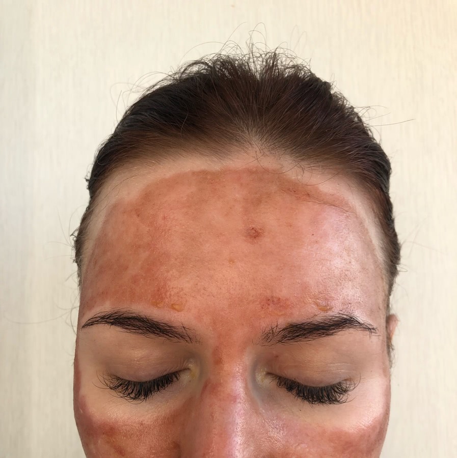 Лазерная шлифовка ожога 3 степени