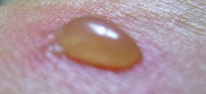 ожог от борщевика фото ожог от борщевика фото