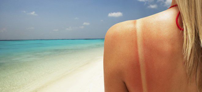 солнечный ожог симптомы солнечный ожог симптомы