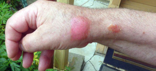ожог от борщевика ожог от борщевика