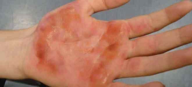 ожог борщевиком ожог борщевиком