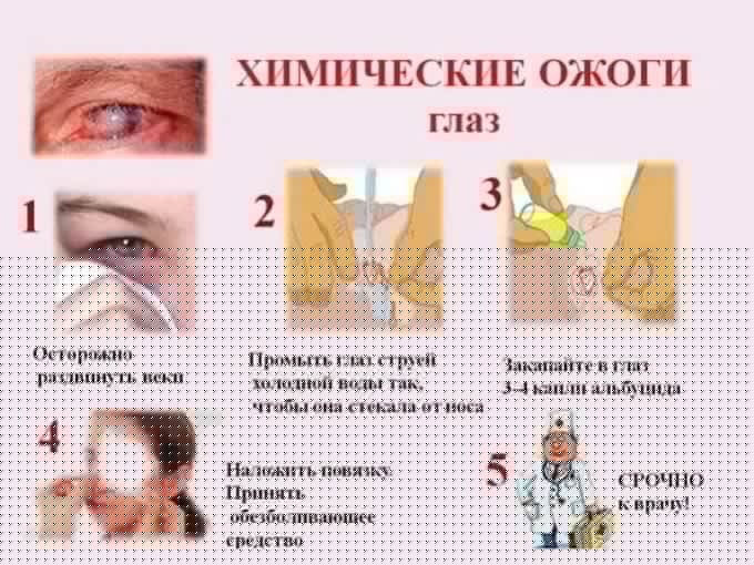 первая помощь при химических ожогах глаз