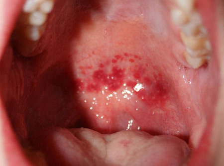 Химический ожог горла