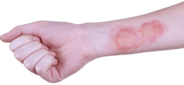 Ожог 1 степени Ожог 1 степени