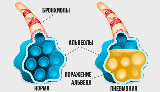 Изменения при пневмонии Изменения при пневмонии