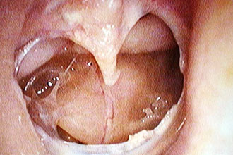 Гнойный отит Гнойный отит