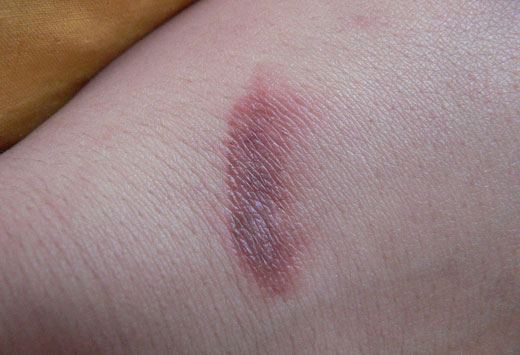 ожог на руке