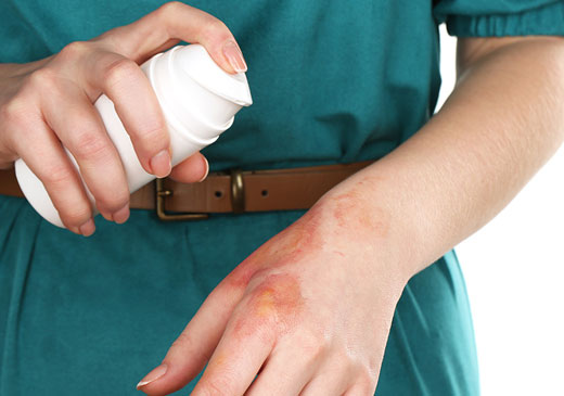 Спрей при ожоге