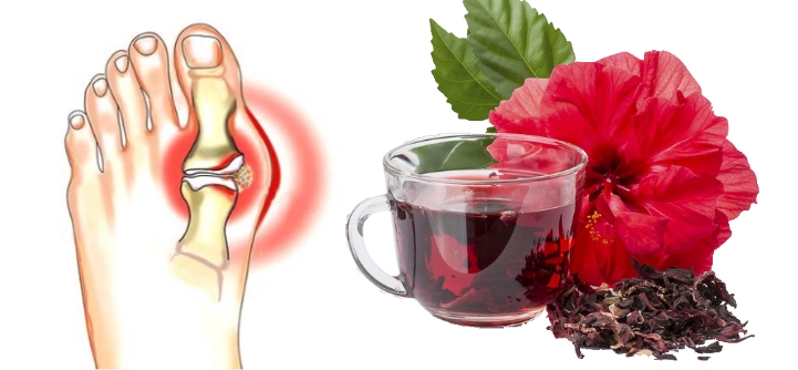 Каркаде при подагре суставов