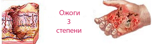 ожог 3 степени