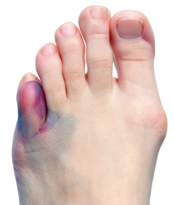 Компресс Димексид с Новокаином. Пропорции, состав, инструкция, как применять для суставов, местного обезболивания