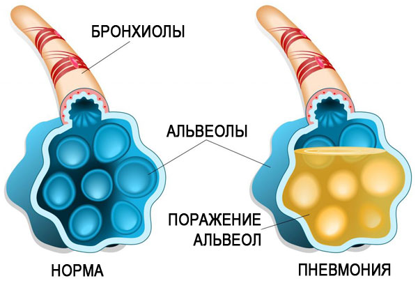 Крупозная пневмония Крупозная пневмония