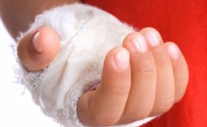 Пузырь после ожога в домашних условиях