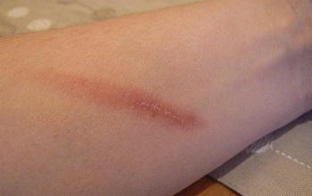 Легкий ожог кожи