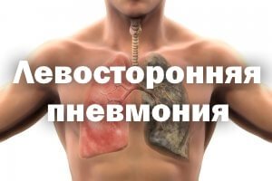 Воспаление левого легкого