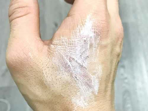 Нанесение жира на ожог Нанесение жира на ожог