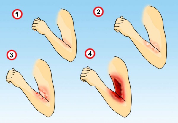 Степени ожогов Степени ожогов