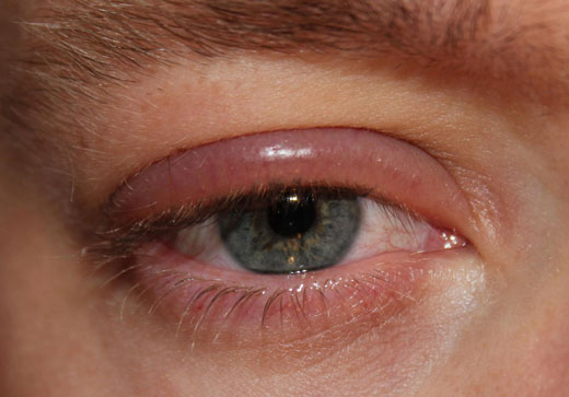 Опухший глаз
