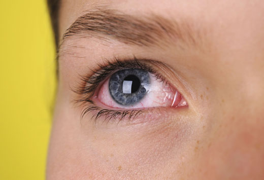 Красные глаза