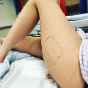 операция по пересадке кожи после ожога