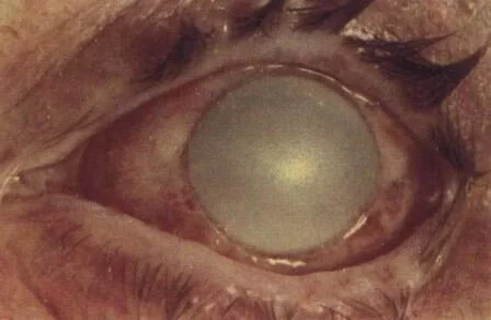 Ожог глаз щелочью по степени тяжести В глаз попал щелочь