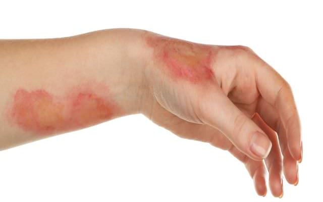 После ожога кожа покрывается коркой