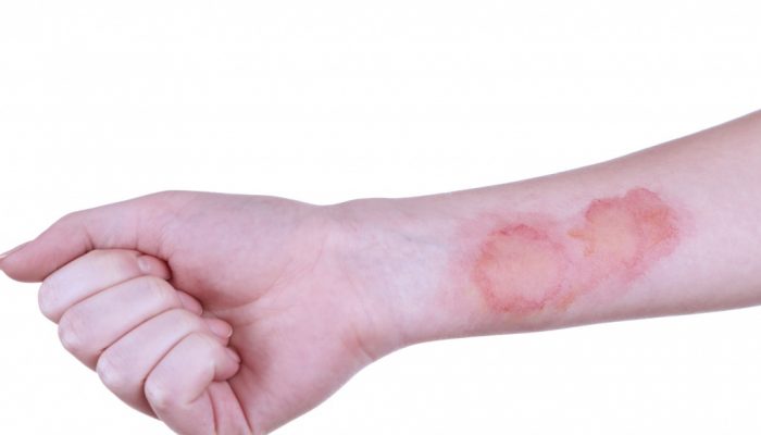 После ожога кожа покрывается коркой