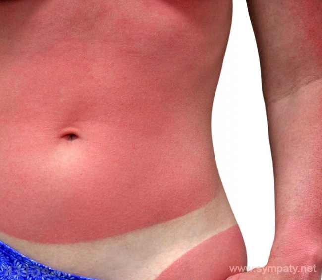 ожог после солярия ожог после солярия