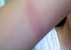 Ожог 1 степени Ожог 1 степени