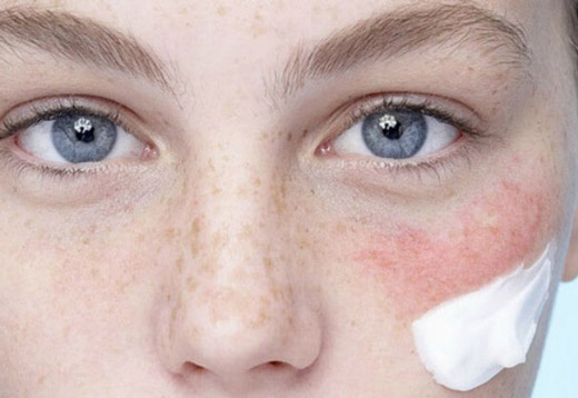 Химический ожог на щеке