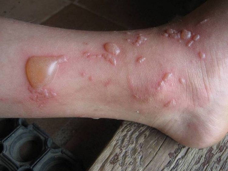 Пузырь после ожога чем лечить