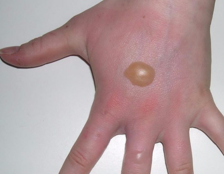 Пузырь после ожога чем лечить