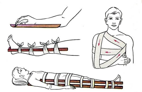 Первая помощь при ушибах вывихах ожогов переломов