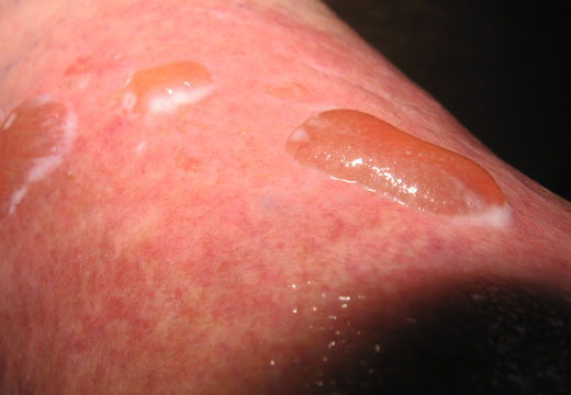 Ожог с волдырем