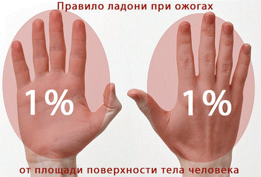 Правило ладони для определения степени ожога