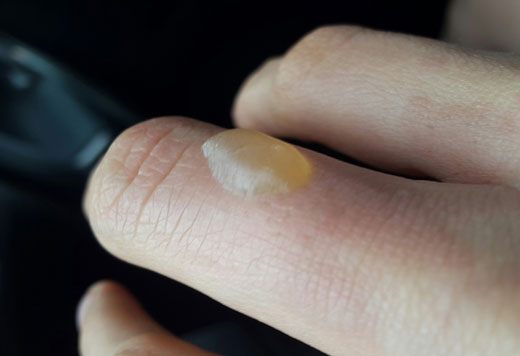 Пузырь от ожога на пальце