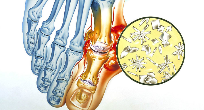 Подагра на ногах лечим домашними условиями