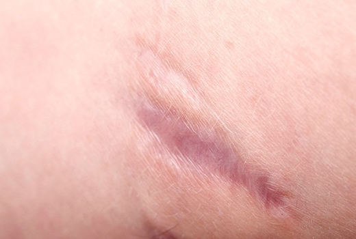 свежий рубец