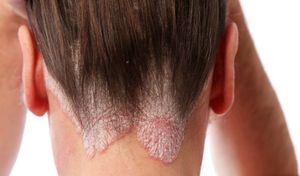 Чем лечат кожу головы после химического ожога