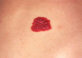 Гемангиома Гемангиома - красное пятно на коже