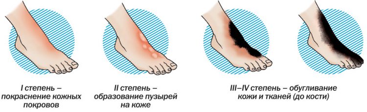 Ожог кипятком пузырь лопнул что делать