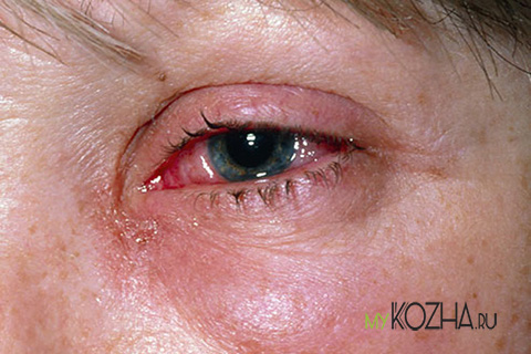 термический ожог глаз