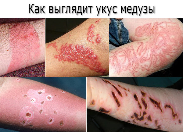 Укус медузы – симптомы (фото) Укус медузы – симптомы (фото)