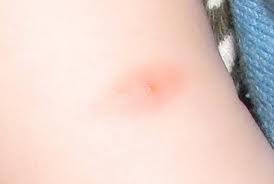 Укус как ожог что это Укус как ожог что это thumbnail