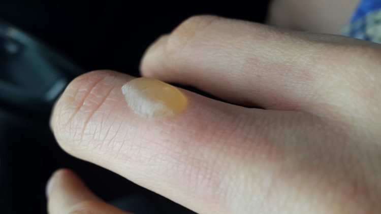 Пузырь после ожога чем лечить