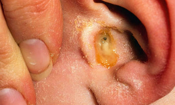 Симптомы внутреннего отита у детей Симптомы внутреннего отита у детей thumbnail