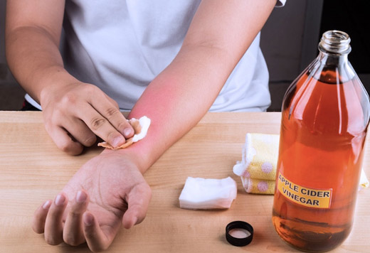 обработка ожога на руке